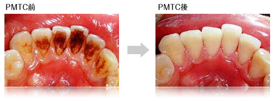 PMTC前 PMTC後 