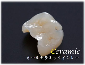 オールセラミックインレー