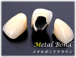 メタルボンドクラウン