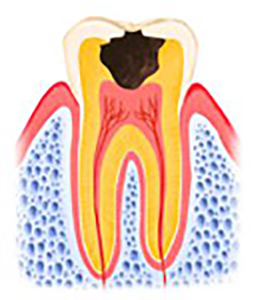 虫歯 C3