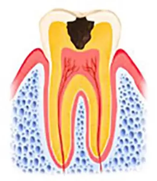 穴が象牙質にまで拡大している状態のイメージ画像