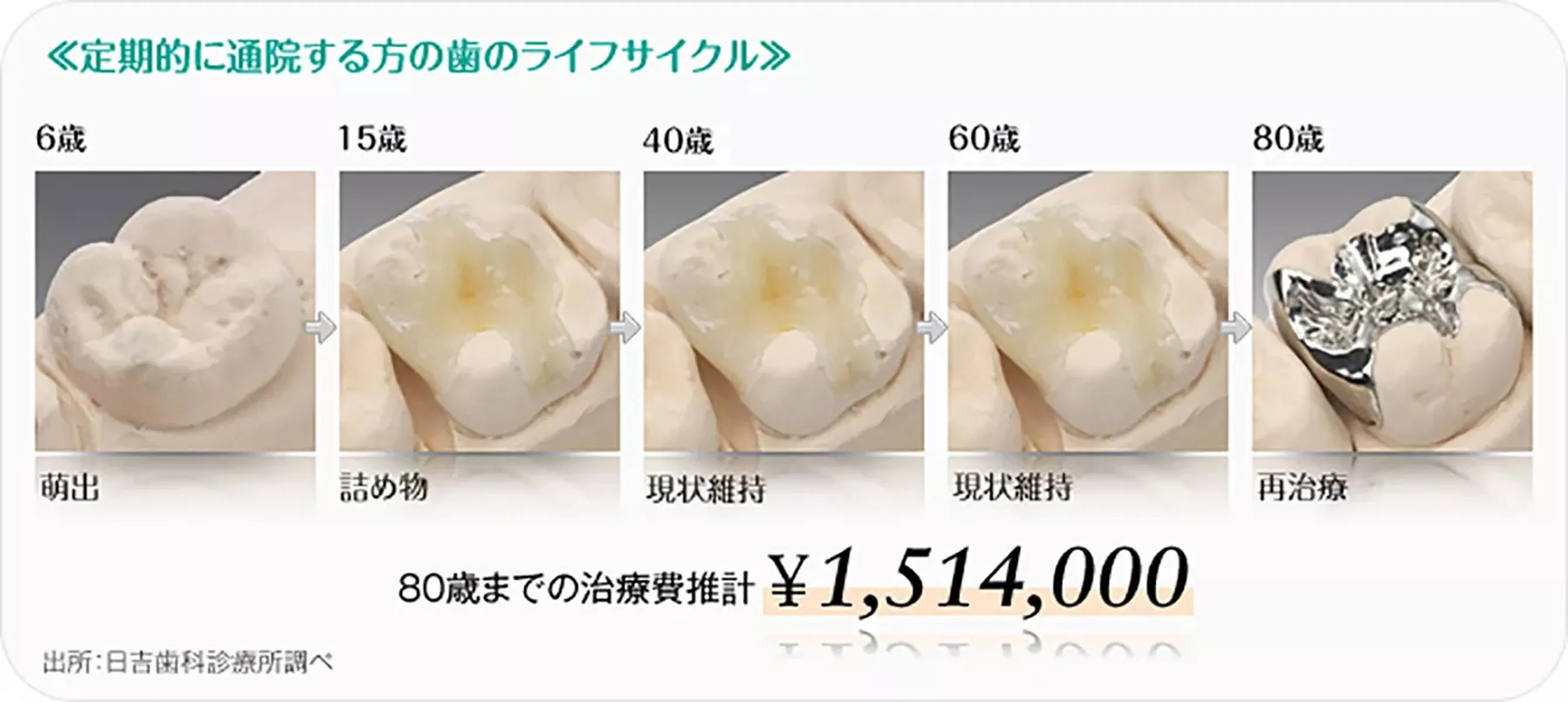 歯のメンテナンス費用を抑えて長持ち
