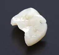 セラミックインレーの画像