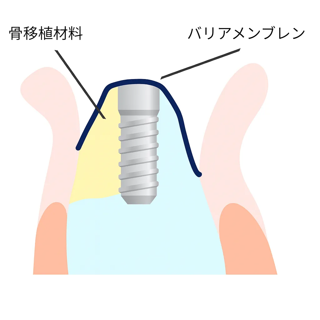 GBRの説明図