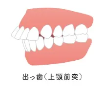出っ歯