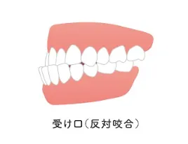 受け口