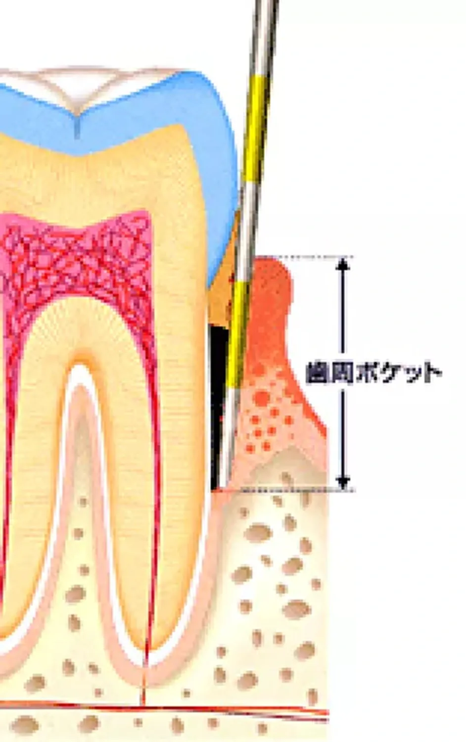 歯周病に関する説明イメージ