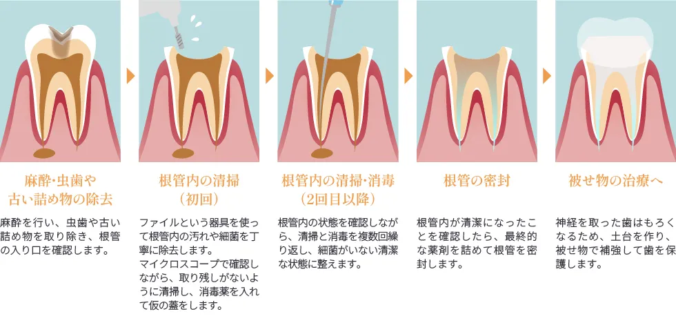 根管治療の流れ