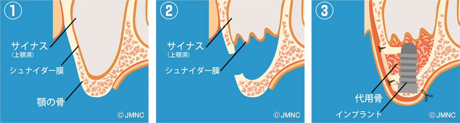 サイナスリフト治療の流れを説明図
